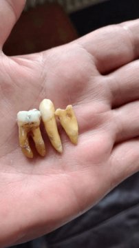 03122024-pulling-teeth3